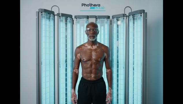 UVB Lamp for Vitiligo Treatment